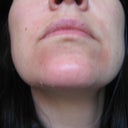 Day 6 peel 1